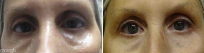 Dual Eye Gel Set with Haloxyl Eyeliss And Matrixyl 3000 Reduces puffiness, eye bags and dark circles