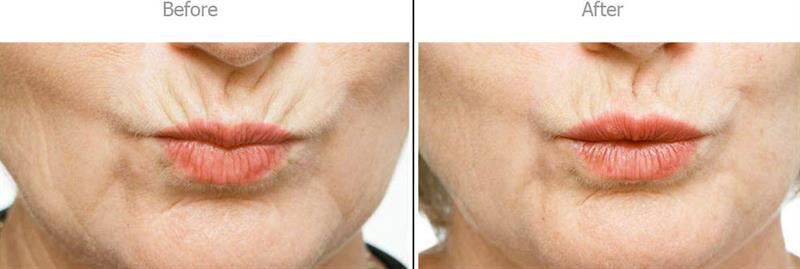 /A peptide complex to add to a cream that reduces upper lip wrinkles