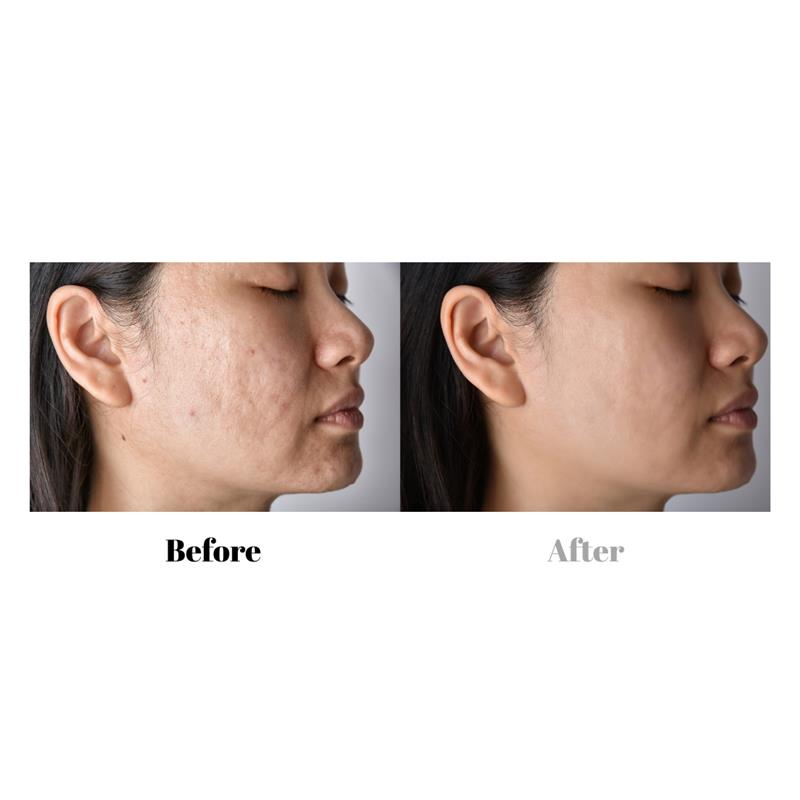 /Cellulite removal peptide additive for mixing cream or serum