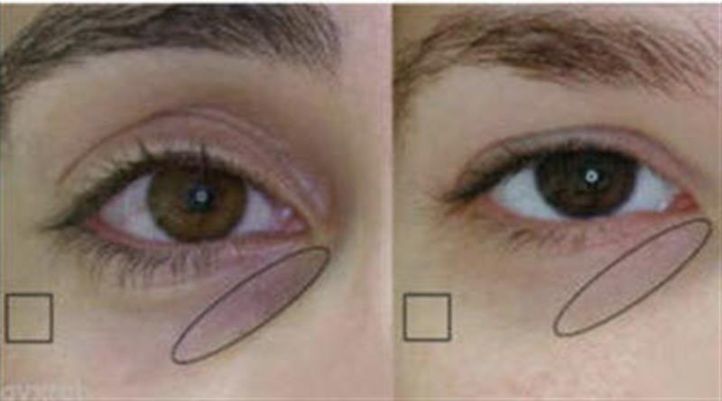 /Triple Illuminating Eye Gel with Haloxyl for treating dark circles around the eyes
